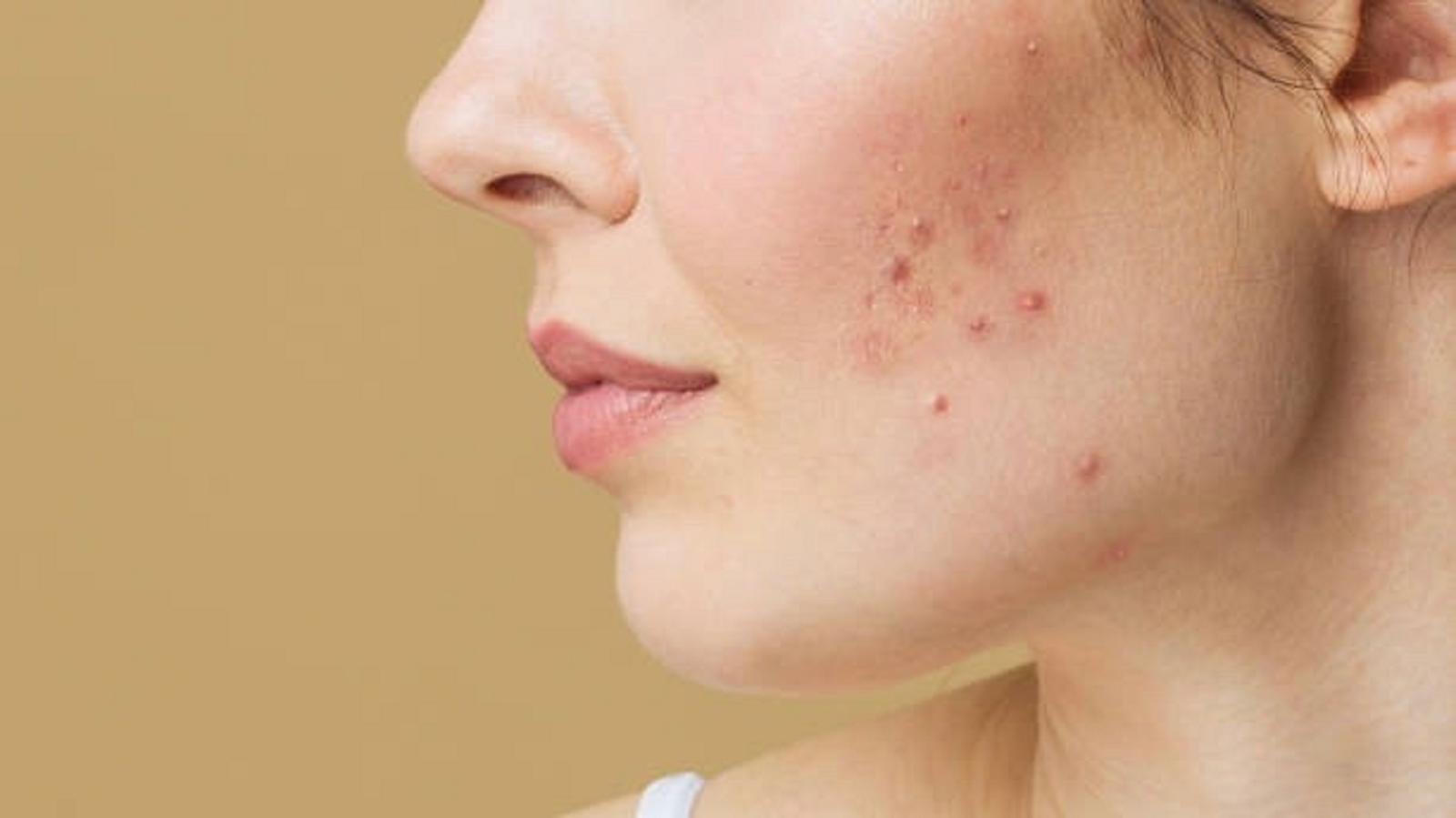 Acne scars and chicken pox scars