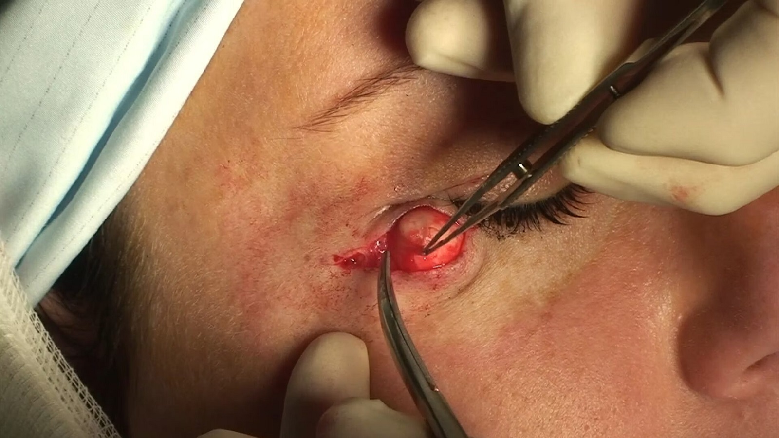 Cyst excision