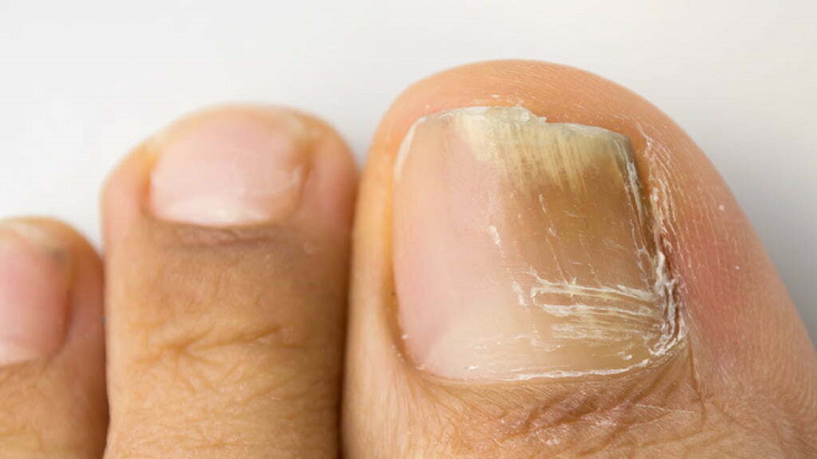 Nail Fungal Infection