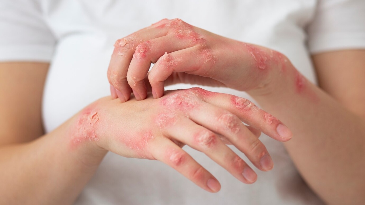 Free Consultation for Leprosy