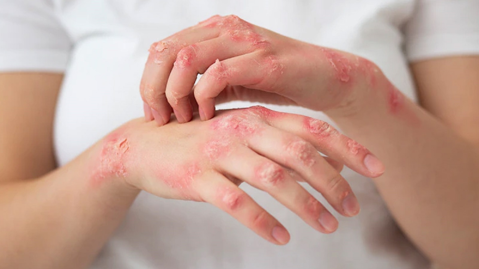 Itching, Urticaria, Fungal Infection, Psoriasis, Eczema, Pigmentary disorder