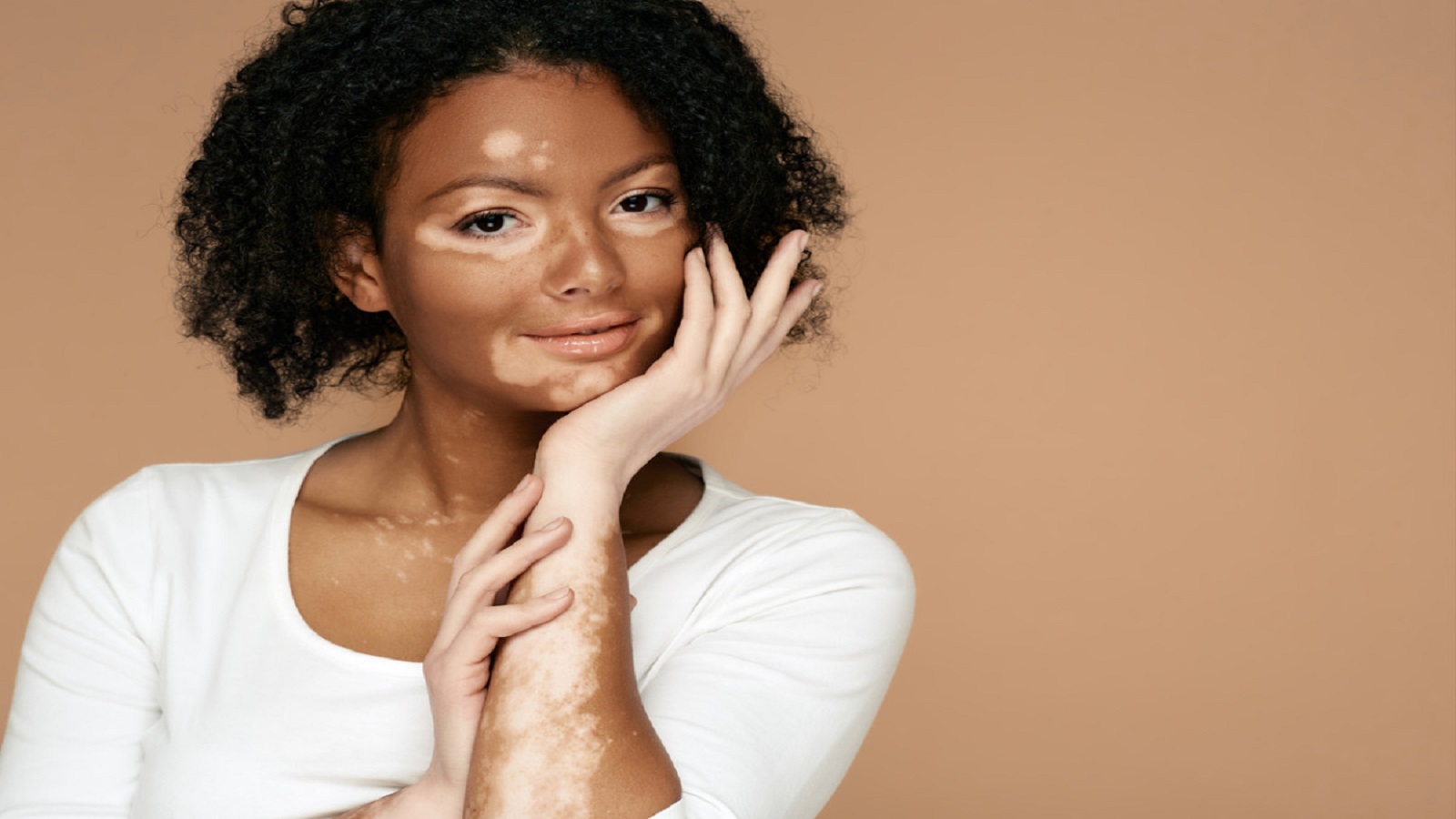 Leukoderma – Vitiligo